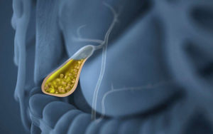 Симптоми жовчних каменів і як вони виникають, фактори ризику і лікування